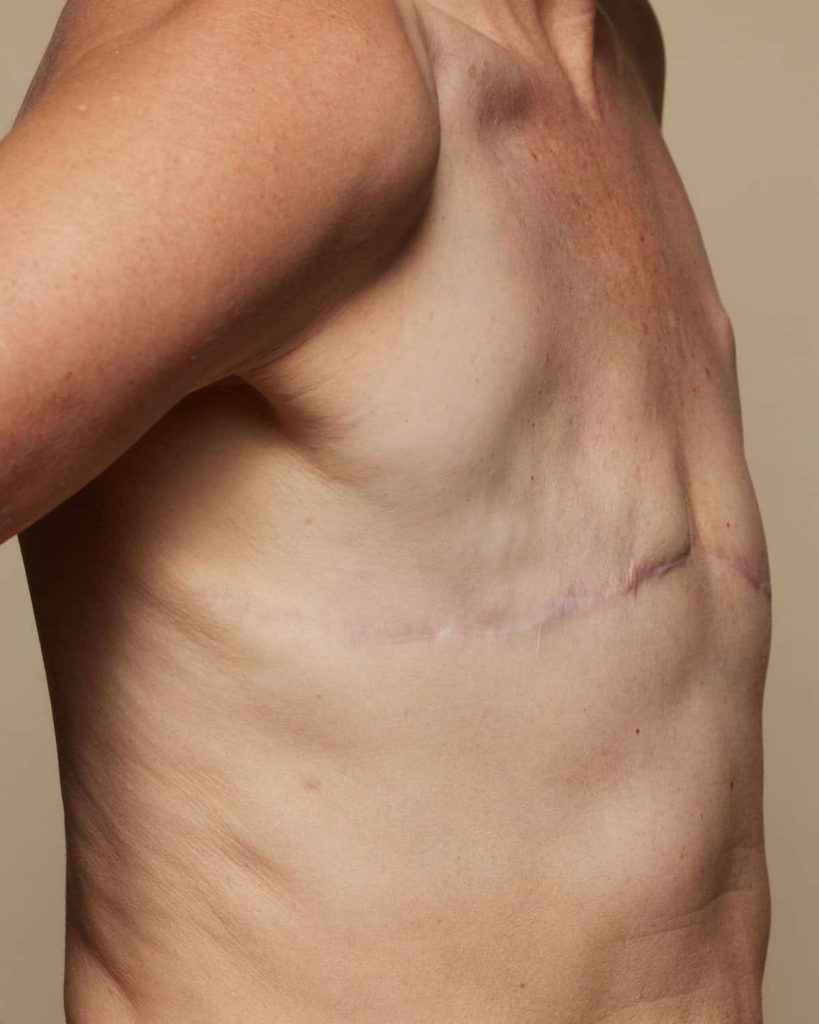 Die traurige Wahrheit hinter meiner gescheiterten Mastektomie mit flachem Verschluss Die traurige Wahrheit hinter meiner gescheiterten Mastektomie mit flachem Verschluss